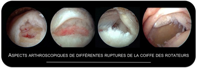 Arthroscopie coiffe des rotateurs