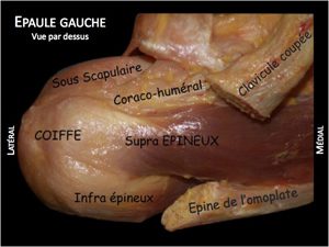 coiffe des rotateurs