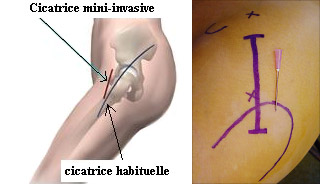 doc1-incisions-comparees