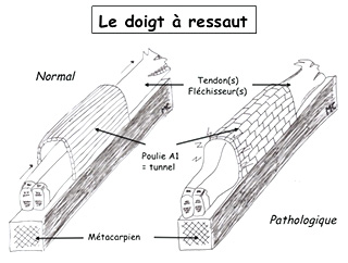 Opération doigt à ressaut