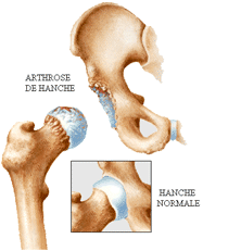 Arthrose de hanche