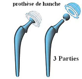 Prothèse de hanche