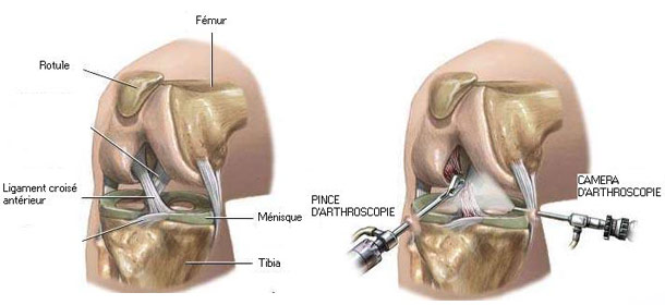 Chirurgie du genou