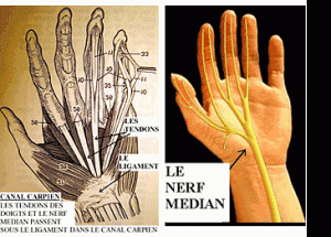 Syndrome du canal carpien