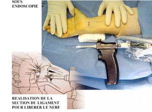 Injection de cortisone