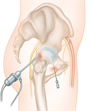 arthroscopie de hanche