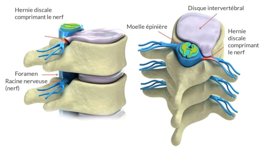 Opération canal lombaire étroit - Chirurgie de la colonne vertébrale