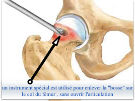 chirurgie de l'effet came