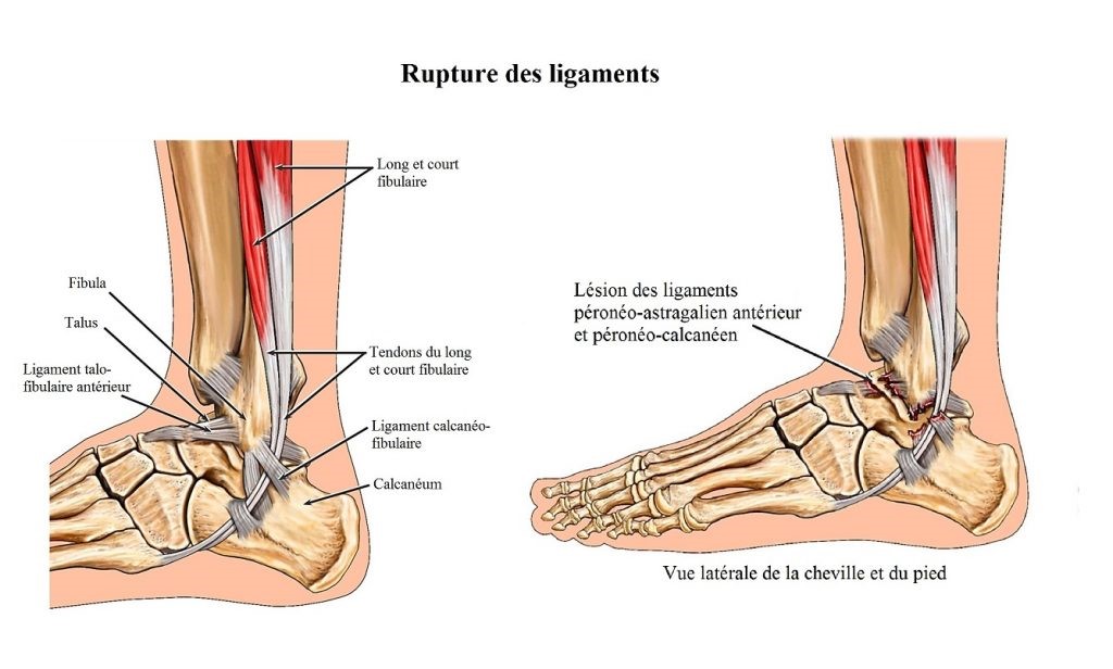 L'entorse de cheville