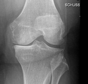 Arthrose du genou (Gonarthrose) - Traitements, opérations & prothèses