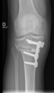 Arthrose du genou : quel est le bon moment pour se faire opérer ? : Femme  Actuelle Le MAG