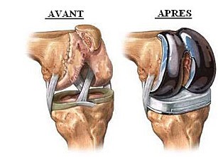 arthrose du genou et de la hanche - Kin-option