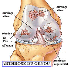 GONARTHROSE : DOULEUR AU GENOU - Enovis France