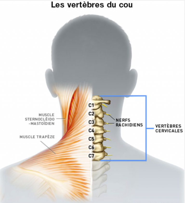 Canal cervical étroit Chirurgie Orthopédique