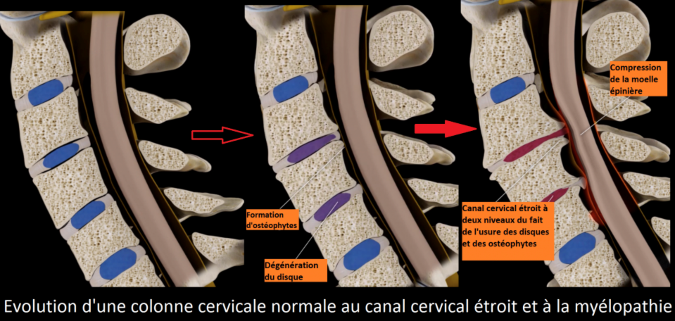 Canal cervical étroit - Chirurgie Orthopédique
