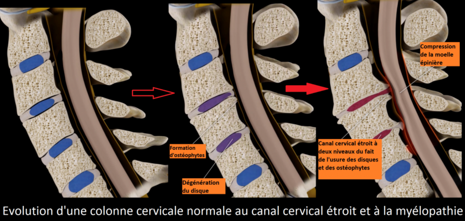 Myélopathie cervico-arthrosique - Chirurgie Orthopédique