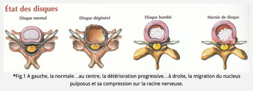 Myélopathie cervico-arthrosique - Chirurgie Orthopédique