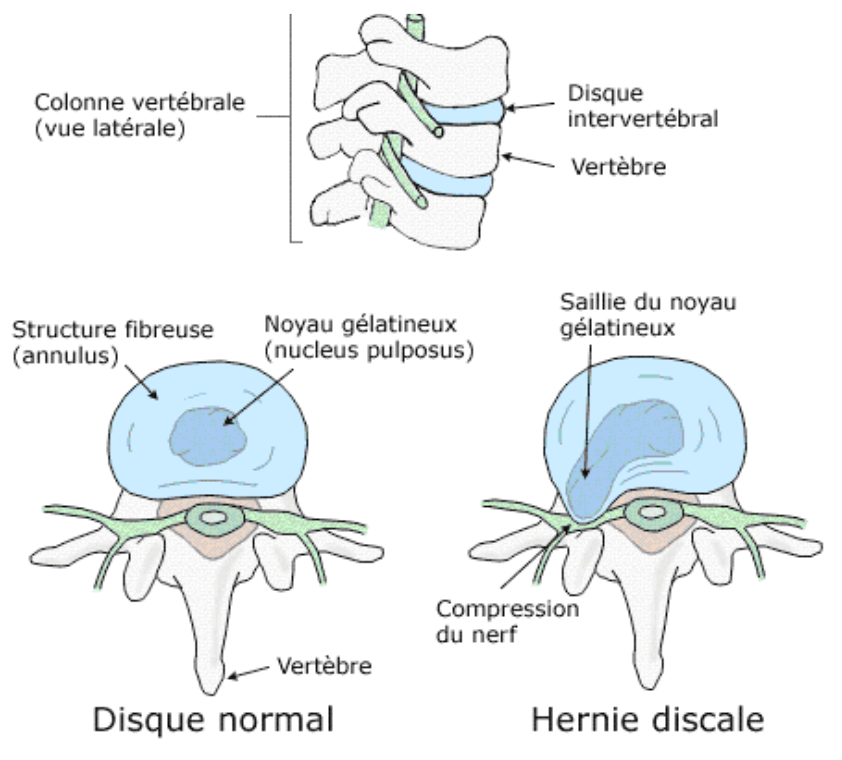 Névralgie cervico-brachiale, Chirurgie de la colonne vertébrale ...