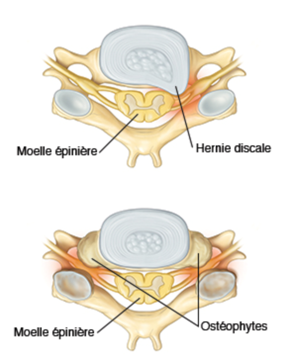 Névralgie cervico-brachiale, Chirurgie de la colonne vertébrale ...