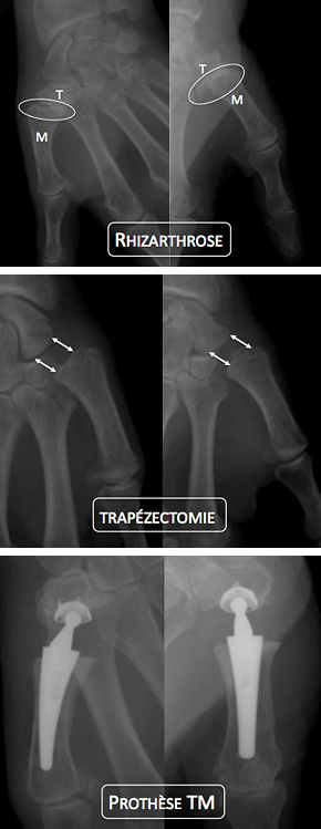 Rhizarthrose ou arthrose du pouce - Groupe Clinique Drouot