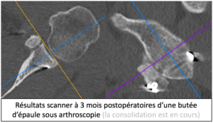 Butée sous arthroscopie et TDM