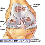 gonarthrose