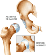 prothèse de hanche